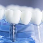 Dental Implant Procedure